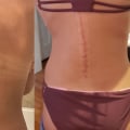 The Pros and Cons of Using Water Resistant SPF on Scars and Wounds
