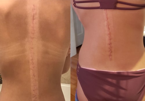 The Pros and Cons of Using Water Resistant SPF on Scars and Wounds